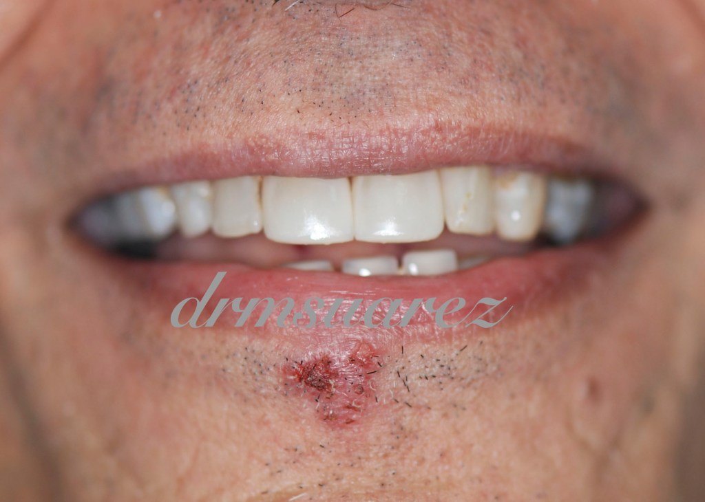 Central incisors restored with direct composite veneer